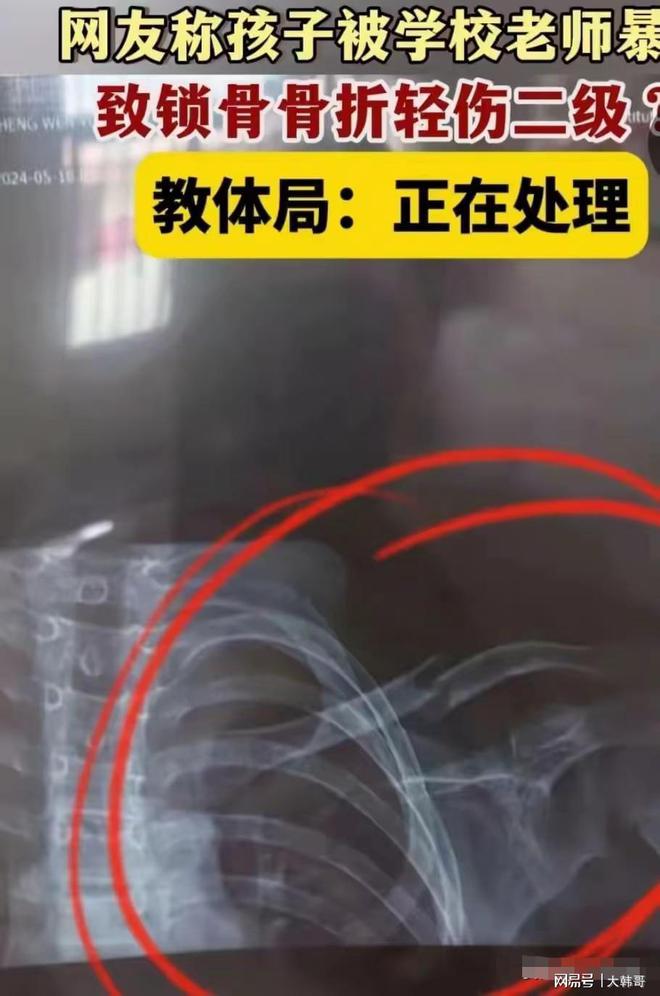 闹大了!日照一学生跳绳慢被体育老师踹断锁骨教育局:已停职熊猫体育(图1) 闹大了!日照一学生跳绳慢被体育老师踹断锁骨教育局:已停职熊猫体育(图1)